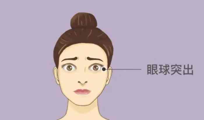 甲亢眼睛病變